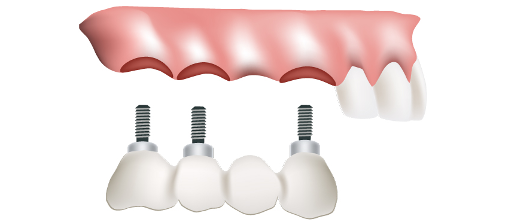 Implant-supported bridges at Southside Dental Implants