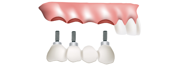 Implant-supported bridges at Southside Dental Implants