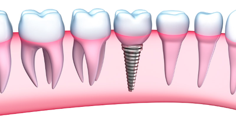 Dental Implants Are Better For Your Oral Health - Southside Dental Implants