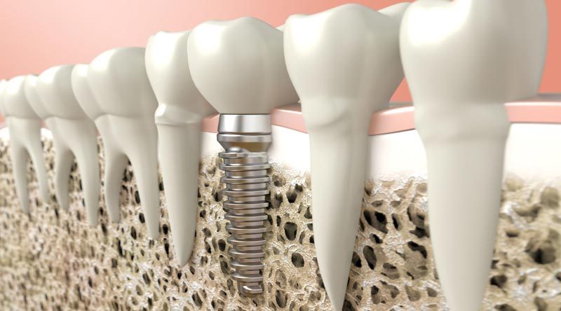 Bone Graft For Teeth Implants - Southside Dental Implants
