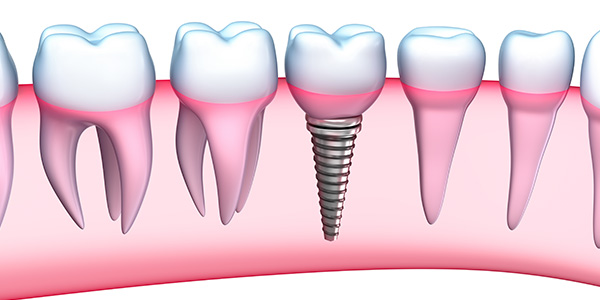 Should I go overseas for dental implants? Dr Burhaan Kassim