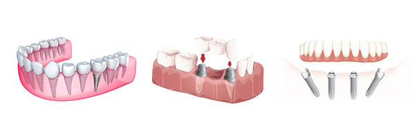 types-of-dental-implants-brisbane