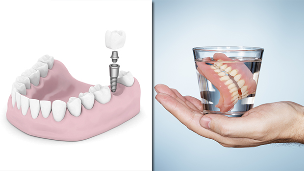 banner-Dental-Implant-versus-Traditional-Dentures